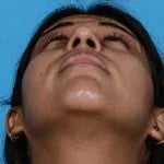 after rhinoplasty front head up view female patient case 1199