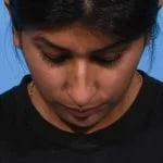 before rhinoplasty front head down view female patient case 1199