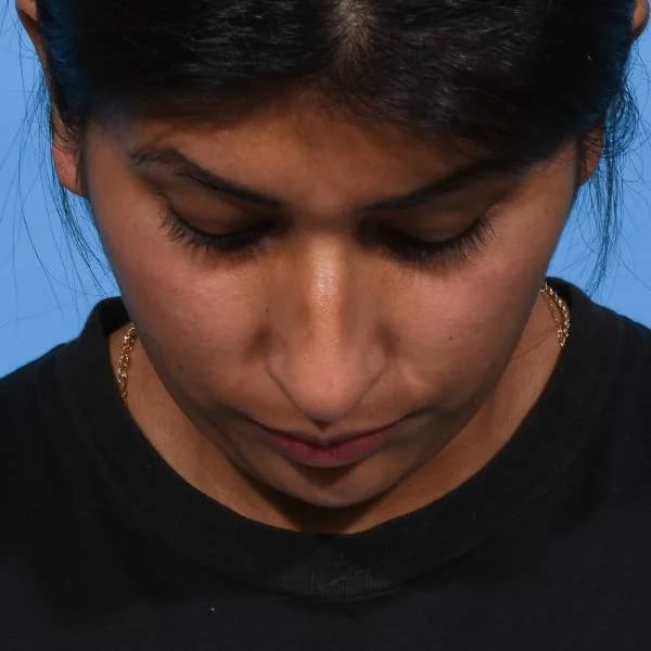 before rhinoplasty front head down view female patient case 1199