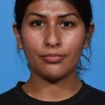 before rhinoplasty front view female patient case 1199