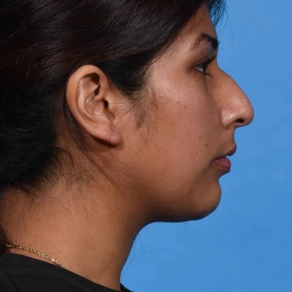 before rhinoplasty right side view female patient case 1199