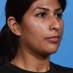before rhinoplasty right angle view female patient case 1199