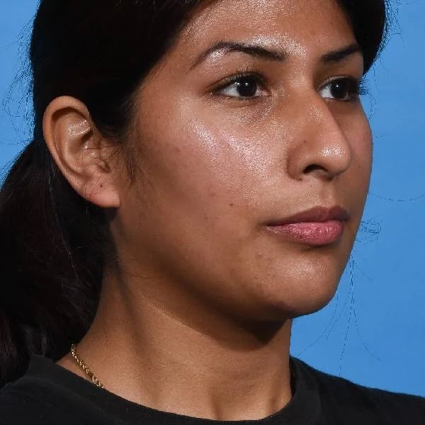 before rhinoplasty right angle view female patient case 1199