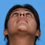 before rhinoplasty front head up view female patient case 1199