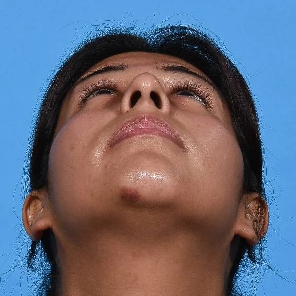 before rhinoplasty front head up view female patient case 1199