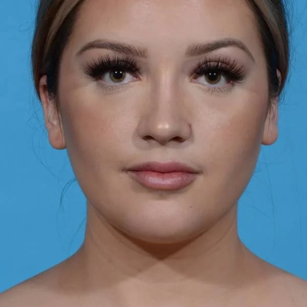 front view of female patient after rhinoplasty case 1210 Palm Beach, FL