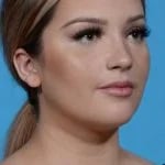 right angled view of female patient after rhinoplasty case 1210 Palm Beach, FL
