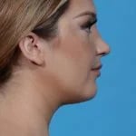 right side view of female patient after rhinoplasty case 1210 Palm Beach, FL