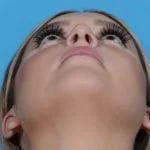 upward angled view of female patient after rhinoplasty case 1210 Palm Beach, FL