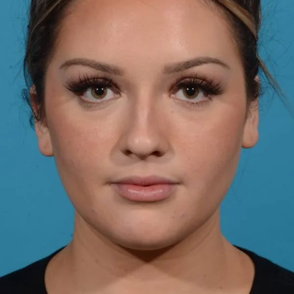 front view of female patient before rhinoplasty case 1210 Palm Beach, FL
