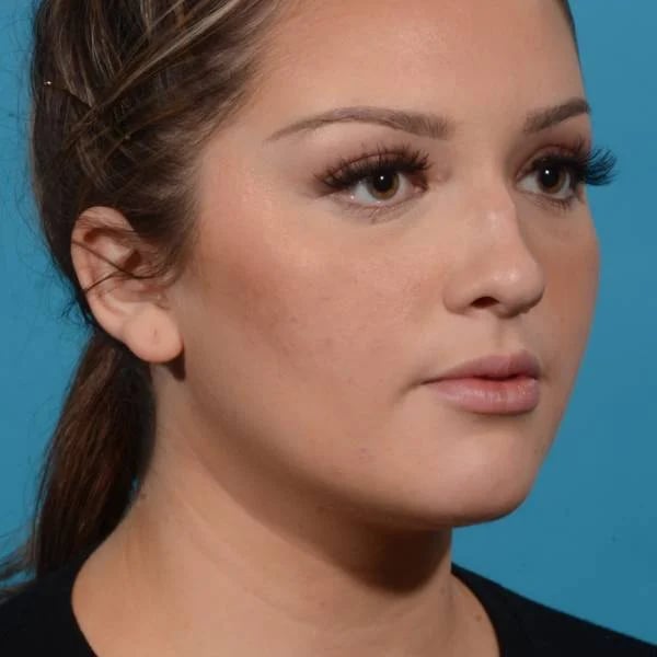 right angled view female patient before rhinoplasty case 1210 Palm Beach, FL