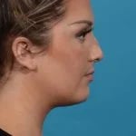 right side profile view of female patient before rhinoplasty case 1210 Palm Beach, FL