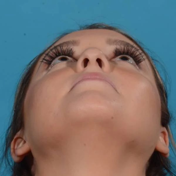 upward facing angle of female patient before rhinoplasty case 1210 Palm Beach, FL
