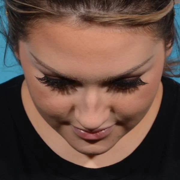 downward facing angle of female patient before rhinoplasty case 1210 Palm Beach, FL