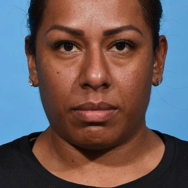 before rhinoplasty front view female patient case 1221