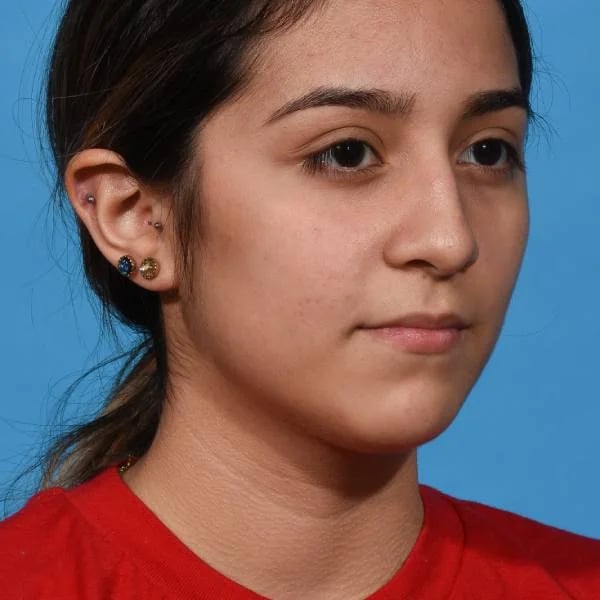 before rhinoplasty right angle view female patient case 1236