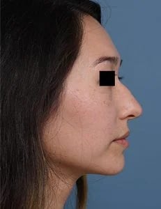 before rhinoplasty right side view female patient case 1676