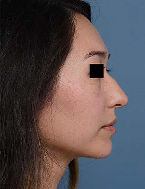 before rhinoplasty right side view female patient case 1676
