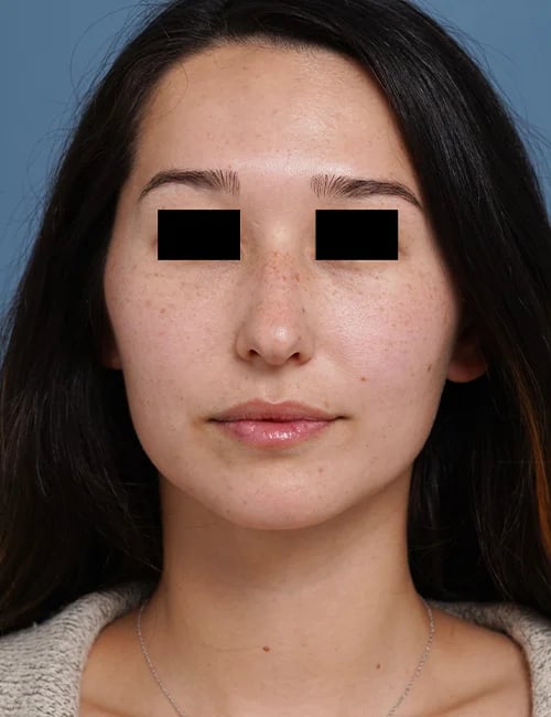 before rhinoplasty front view female patient case 1676