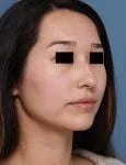 before rhinoplasty right angle view female patient case 1676