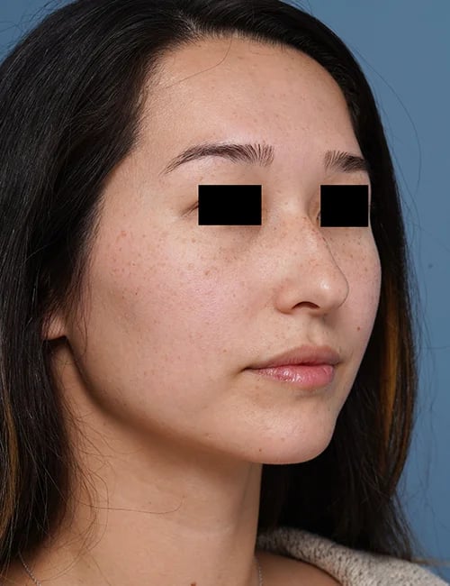 before rhinoplasty right angle view female patient case 1676