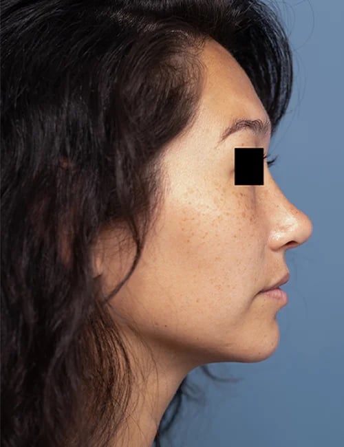 after rhinoplasty right side view female patient case 1676