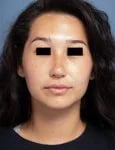 after rhinoplasty front view female patient case 1676