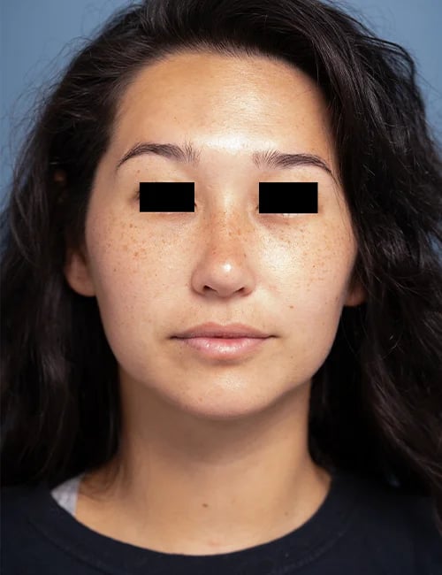 after rhinoplasty front view female patient case 1676