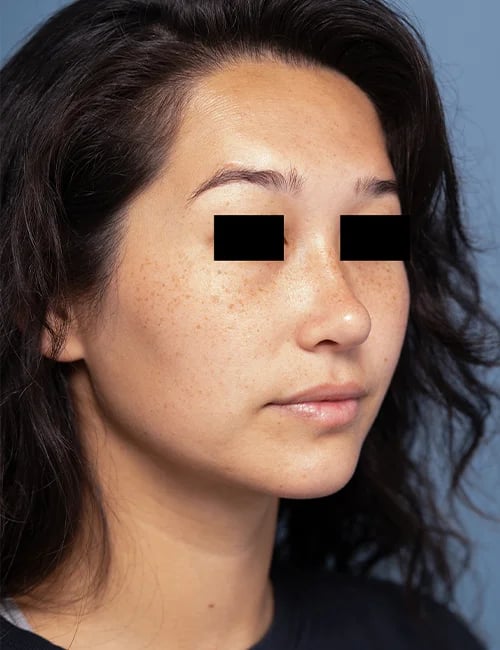 after rhinoplasty right angle view female patient case 1676