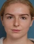 before rhinoplasty front view female patient case 1685