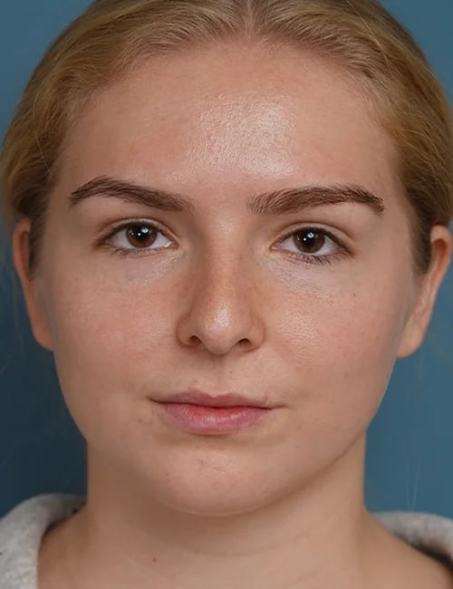 before rhinoplasty front view female patient case 1685