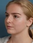 before rhinoplasty left angle view female patient case 1685