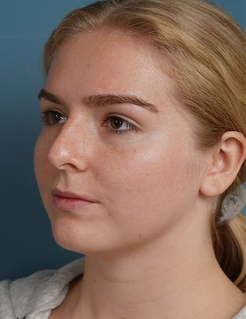 before rhinoplasty left angle view female patient case 1685