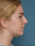before rhinoplasty right side view female patient case 1685