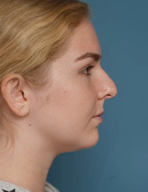 before rhinoplasty right side view female patient case 1685