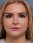after rhinoplasty front view female patient case 1685
