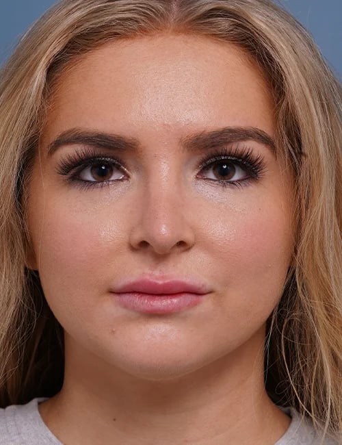 after rhinoplasty front view female patient case 1685