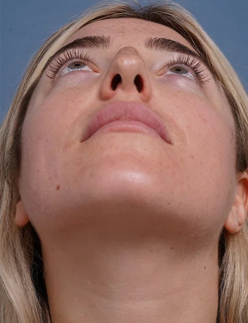 before rhinoplasty front head up view female patient case 1698