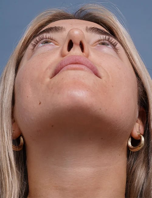 after rhinoplasty front head up view female patient case 1698