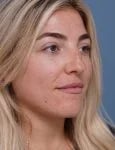 before rhinoplasty right angle view female patient case 1698