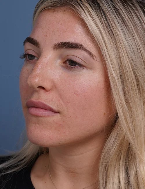 before rhinoplasty left angle view female patient case 1698