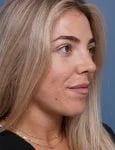after rhinoplasty right angle view female patient case 1698