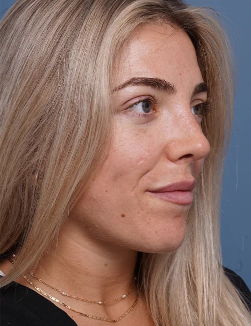 after rhinoplasty right angle view female patient case 1698