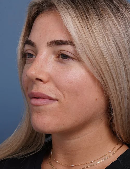 after rhinoplasty left angle view female patient case 1698
