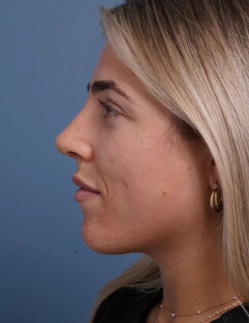 after rhinoplasty left side view female patient case 1698