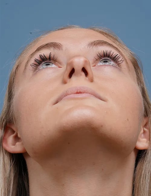 before rhinoplasty front heads up view female patient case 1711
