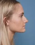 before rhinoplasty right side view female patient case 1711