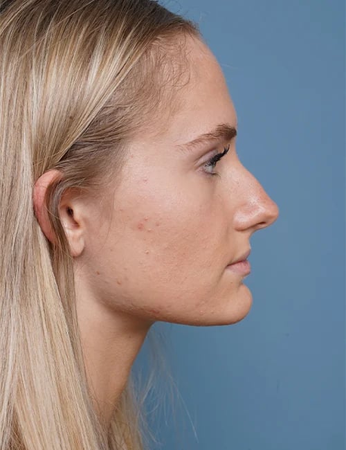 before rhinoplasty right side view female patient case 1711