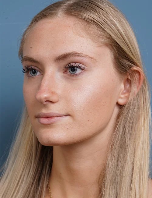 before rhinoplasty left angle view female patient case 1711