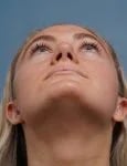 after rhinoplasty front heads up view female patient case 1711
